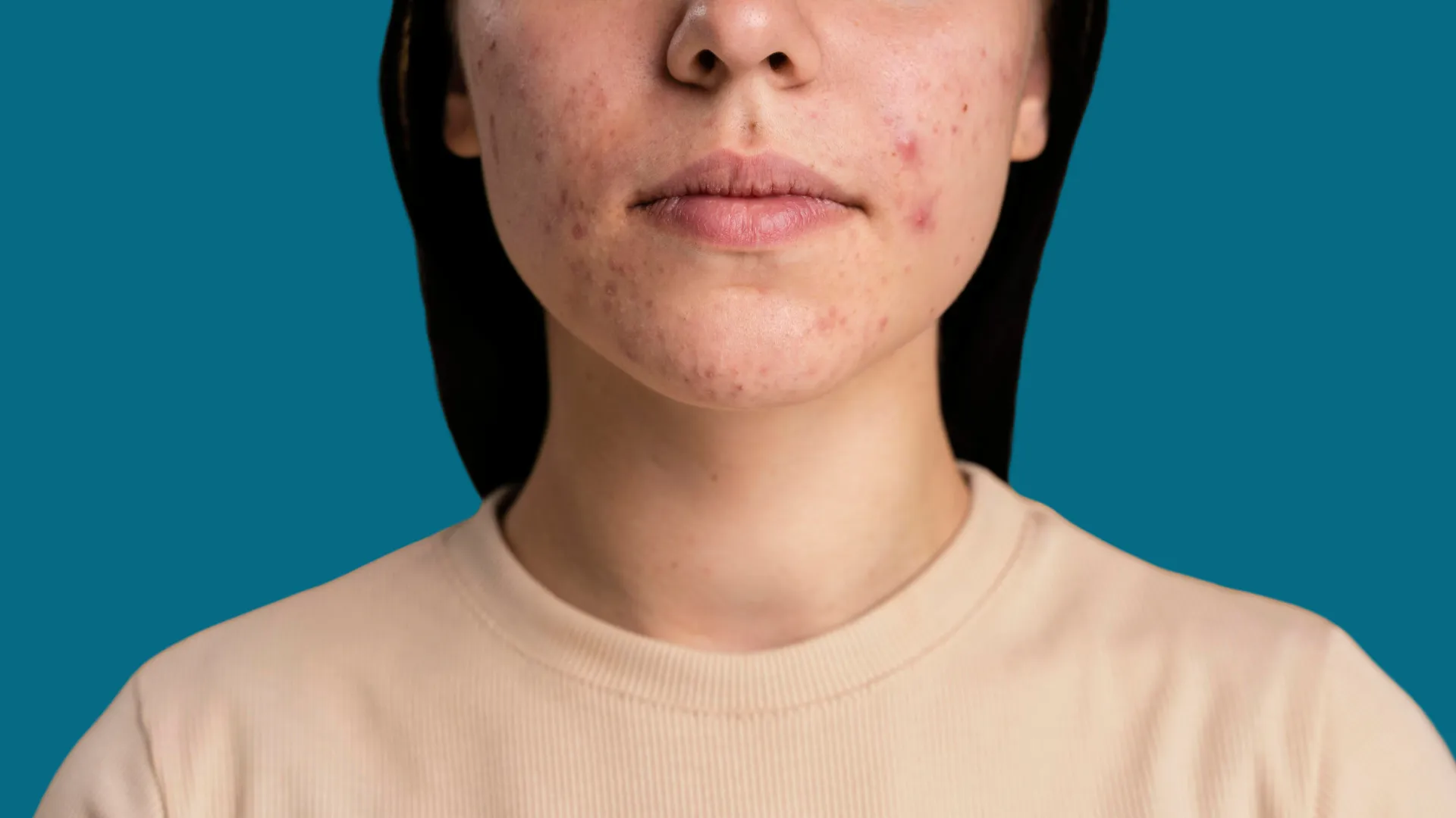 Acne da Mulher Adulta