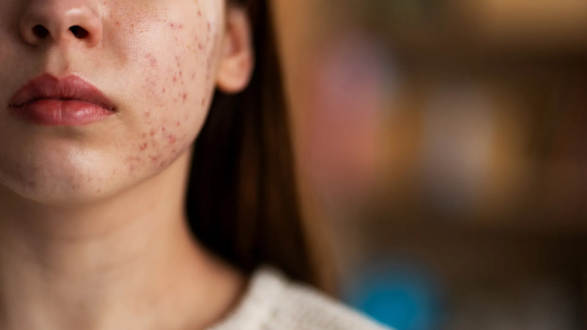 Início 12 tratamento tópico da acne
